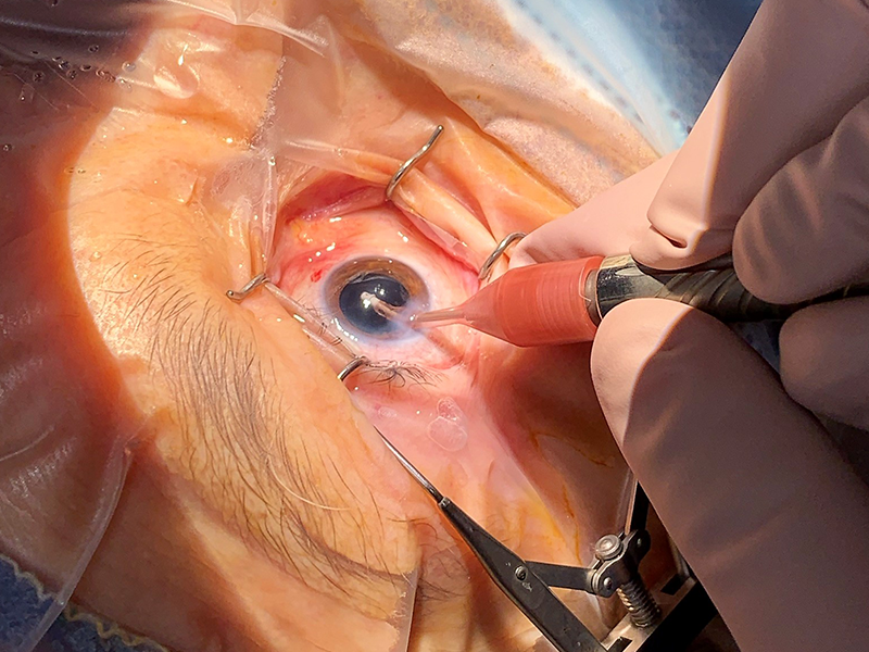 Cataract procedure at St. Mary's General Hospital